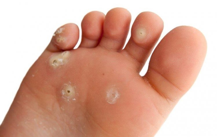 This is how you can remove a small wart without any pain