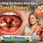 TonsilStones.net The Practical Guide for Tonsil Stones, Bad Breath, and Safe Relief